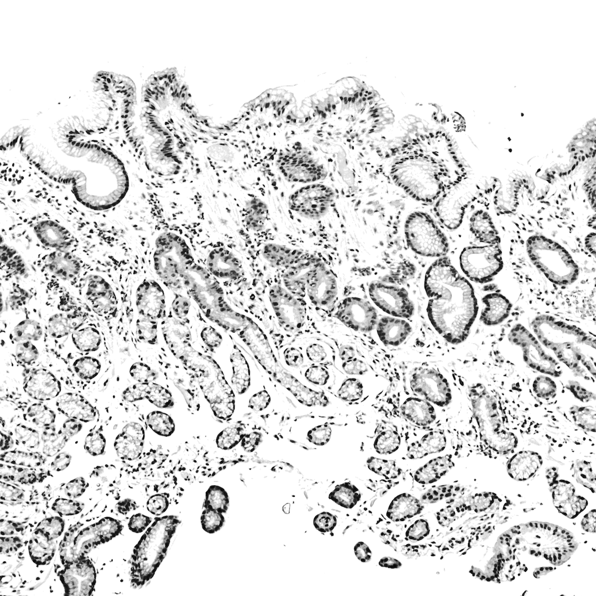 Gastric_antral_vascular_ectasia_ _intermed_mag%20BW%20copia-1