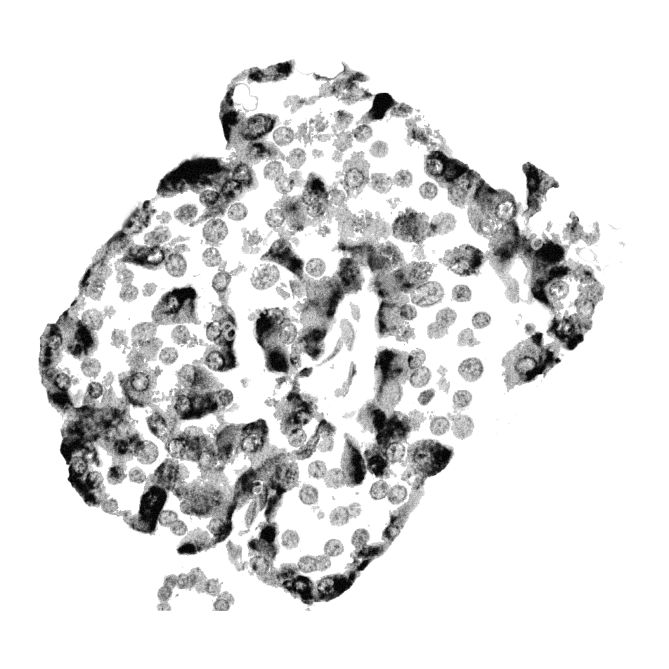 Gastric_antral_vascular_ectasia_ _intermed_mag%20BW%20copia-1