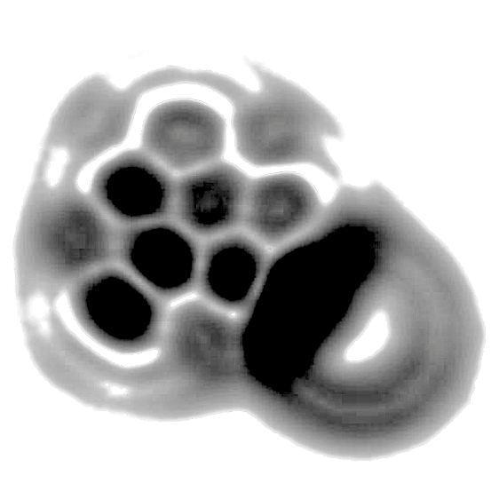 citologia cellule-tumorali-peritoneo%20copia%20BW