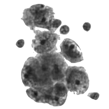 citologia cellule-tumorali-peritoneo%20copia%20BW